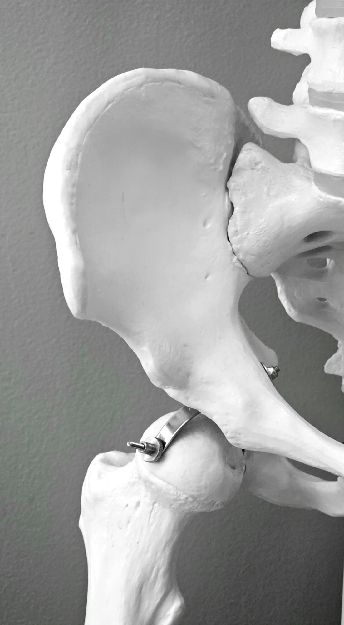 Is Hip Replacement Right for You? Here&rsquo;s What to Know