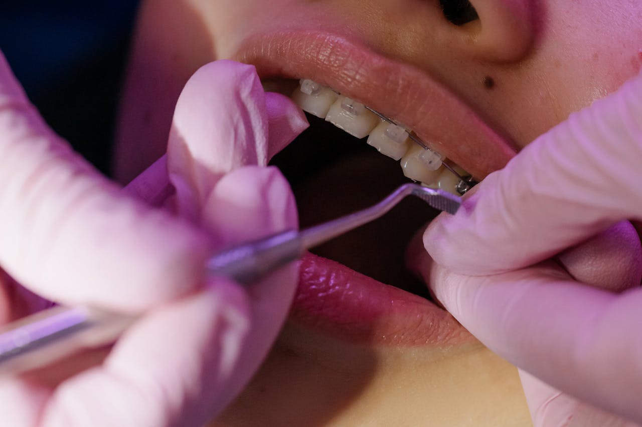 Invisalign vs Braces: Which Option Is Better for Adults? 6 Key Differences