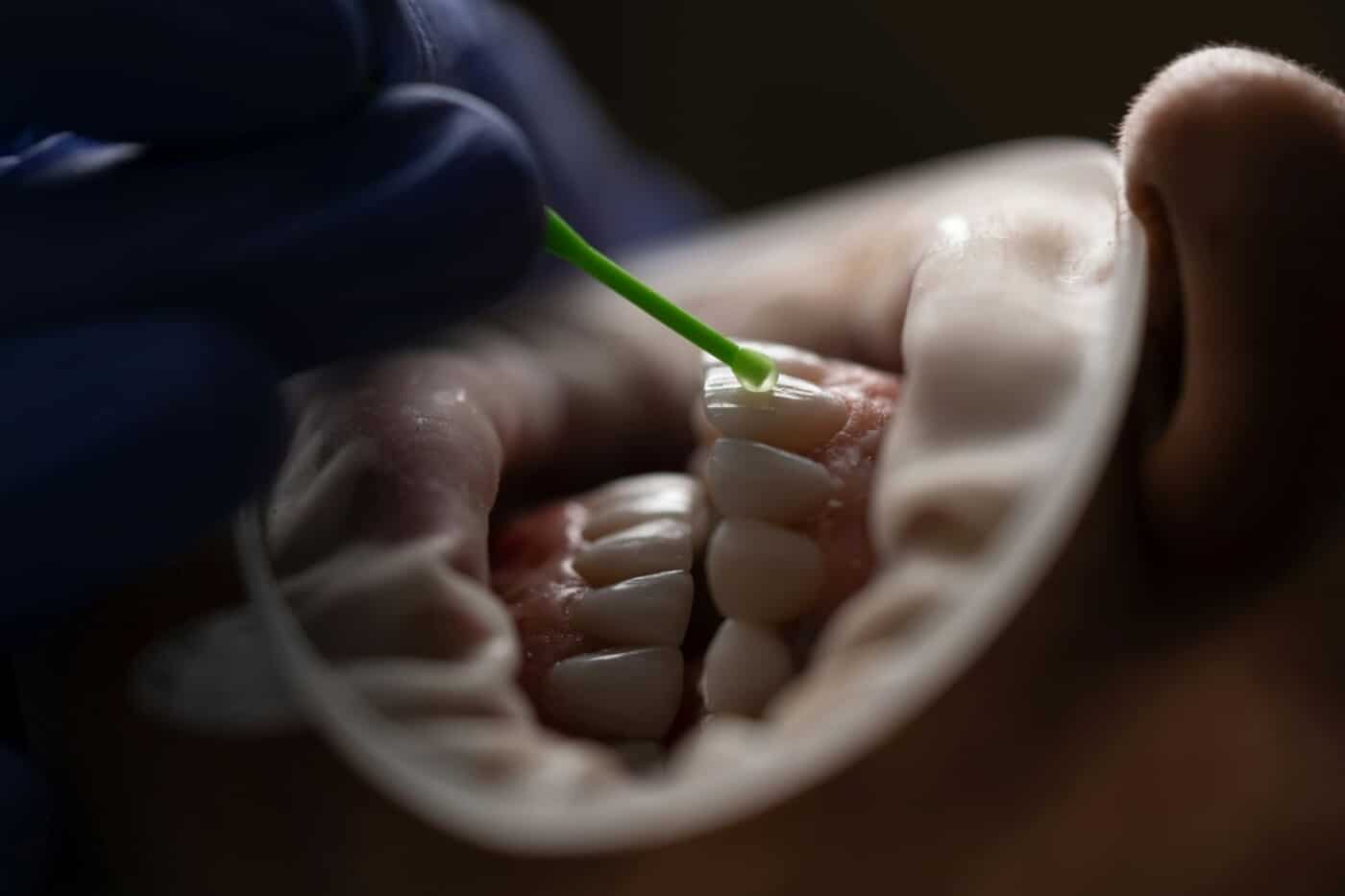 What Composite Bonding Can Do for Your Smile